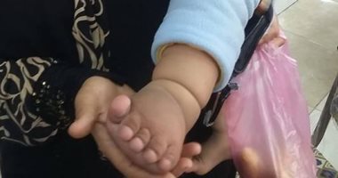 بالصور..مأساة أم بالشرقية تعجز عن توفير جورب طبى لطفلتها المصابة بمرض نادر