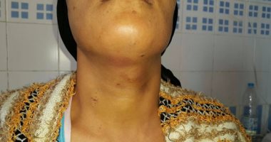 بالصور.. إجراء أول عملية لاستئصال الغدة الدرقية بالمنظار فى جامعة المنصورة