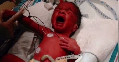 بالصور.. إجراء عملية جراحية لجنين فى بطن أمه