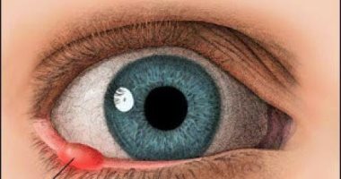 أستاذ طب عيون يكشف عن تقنية جديدة لعلاج الأكياس الدهنية بالعين