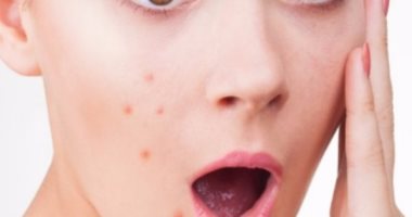 روشتتك لعلاج حبوب الوجه فى الصيف.. تجنبى المكياج والتعرض لأشعة الشمس
