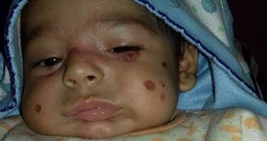 بالصور.. رضيع يولد بمرض نادر بالمحلة ووالده يستغيث لعلاجه بالخارج