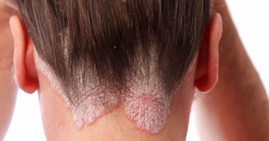 "FDA" تصدق على مرهم جديد لعلاج الإكزيما