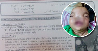 مأساة أسرة فى رحلة البحث عن علاج طفل فى .. "سعيد" ولد بعيب خلقى يقسم وجهه وأنفه ويحتاج لجراحة دقيقة.. الأطباء ينصحون بضرورة سفره للخارج.. ووالده يناشد وزير الصحة لإنقاذ ابنه 