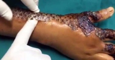 بالفيديو.. بدون عمليات تجميل علاج الحروق من الدرجة الثانية بقشر السمك