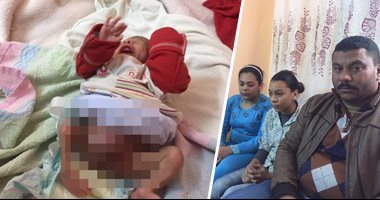 أطباء الغربية يعجزون أمام حالة طفل بعد ولادته بعضوين ذكريين وفتحتى شرج