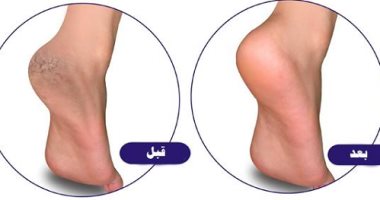 بالخطوات .. وصفة طبيعية للتخلص من مشاكل تشقق القدمين