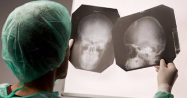 أعراض نزيف المخ ومضاعفاته الخطيرة