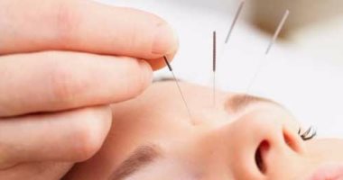 الوخز بالإبر علاج صينى قديم يمكن أن يساعد على فقدان الوزن ولكن احذر من مخاطره