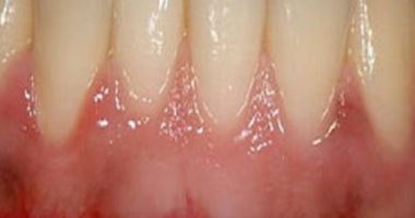 انتبه.. تناول المثلجات على الإفطار يعرضك لالتهاب الحلق والحنجرة