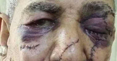بالصور.. 135 غرزة فى وجه "عم سعيد" بسبب 700 جنيه.. والجانى يهدده بالقتل