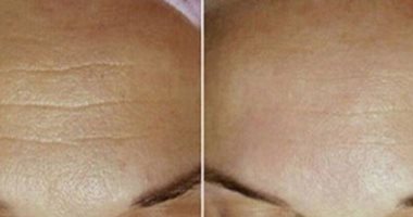 وصفة طبيعية للتخلص من التجاعيد فى 7 أيام