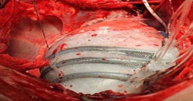 اكتشاف عقار لعلاج السكر يقلل من مخاطر الإصابة بأزمات قلبية وأمراض الكلى