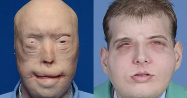 على طريقة "FACE OFF".. طبيب يعيد الابتسامة للمرضى بزراعة وجه كامل