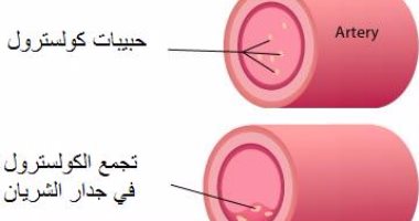استشارى قلب: ارتفاع نسبة الكوليسترول عن 130مجم يسبب تصلب الشرايين 