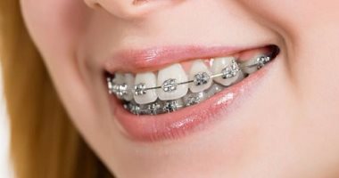 س و ج .. كل ما تريدين معرفته عن تقويم أسنانك التجميلى فى 6 أسئلة