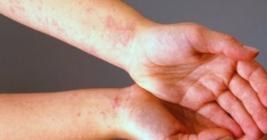 زيت الساتونيلا ومضادات الالتهاب أبرز علاجات حساسية الناموس المفرطة