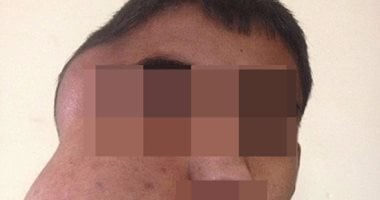 بالصور.. أطباء ينجحون فى إزالة ورم بحجم كرة من أنف صبى
