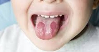 العسل والزبادى أفضل علاجات لحروق اللسان