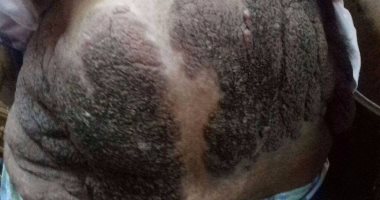 تشوهات نادرة تُصيب غادة بـ"الشلل".. وأسرتها تحلم بـ"طبيب" قادر على علاجها 