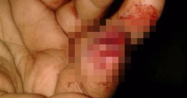 سيدة تقطع "عقلة" إصبع جارتها بأسنانها بسبب لهو الأطفال فى الشرقية