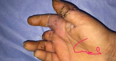 نجاح جراحة لتثبيت إصبعى طفل تعرضا للبتر بمستشفى الأزهر بدمياط