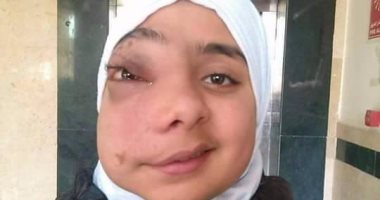 مأساة "ندى".. تعانى من وحمة دموية تتشعب فى الوجه وتحتاج جراحة عاجلة 