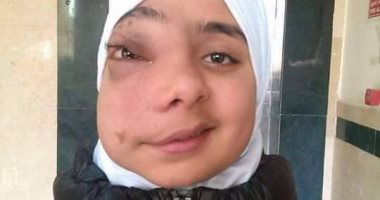 "ندى" طفلة تعانى من ورم أزال ملامح الطفولة عن وجهها