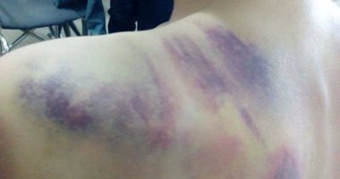 رواد فيس بوك يتداولون صور طفل عليه آثار تعذيب.. ويؤكدون: زوجة والده السبب