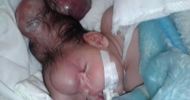  محافظ كفر الشيخ : نقل طفلة لإجراء عملية تعاني من عيب خلقى على نفقة المحافظة