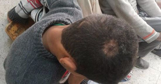 بالصور.. ظهور 7 حالات قراع عسلى و3 حالات تنيا فى مدرسة ابتدائية بسوهاج