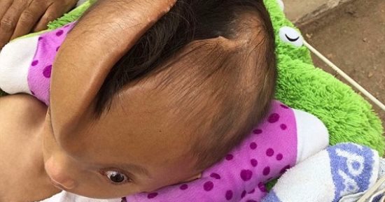 بالصور.. حالة نادرة لطفل يعانى من شق بالجمجمة