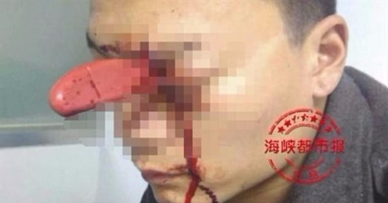 "ديلى ميل": صينى ينتظر دوره بهدوء بمسشتفى وسكين مغروس فى عينه