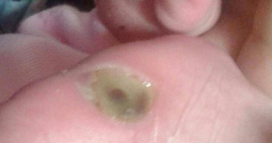 بالصور.. حرق قدم مولود عمره 9 أيام بسبب الإهمال الطبى فى مستشفى بشبرا