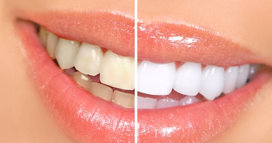 تخلصى من اصفرار الأسنان واحصلى على ابتسامة مميزة مع زيت جوز الهند