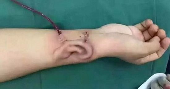 بالصور.. أطباء صينيون ينقلون أذن مريض لرأسه بعد نجاح زراعتها فى ذراعه