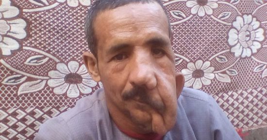 صاحب الوجه المترهل بالمنيا: أحتاج عملية تجميل بـ20 ألف جنيه