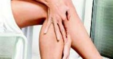 علامات تشير لإصابتك بمرض دوالى الوريد.. أبرزها تورم الساقين والتشنجات