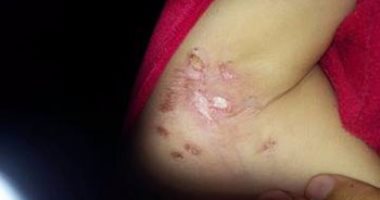 زوج أم يتجرد من إنسانيته ويعذب طفلة لمدة 3 شهور