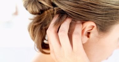 5 وصفات طبيعية تعالج مشكلة تهيج فروة الرأس فى الصيف