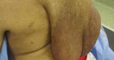 بالصور..فريق طبى يستأصل ورم يزن 2 كيلو من ظهر سيدة بأسوان