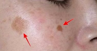 لو بتعانى من البقع الداكنة.. 6 نصائح لإزالتها بشكل سريع