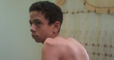 بالصور.. "مهاب" مصاب باعوجاج فى العمود الفقرى ويحتاج لإجراء عملية عاجلة