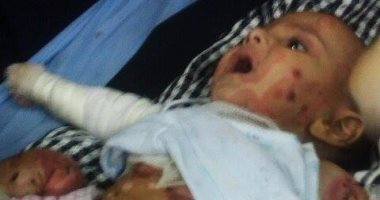 بالصور.. مرض نادر"ينهش" جلد"ريتاج" وعمها يطالب المسئولين بالتدخل لإنقاذها