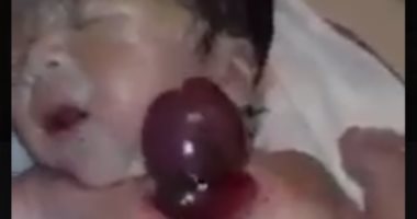 بالفيديو.. طفلة تعيش بقلب نابض خارج الجسد