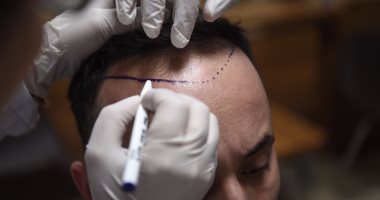 زراعة الشعر فى مصر vs تركيا.. تعرف على فرق أسعار البلدين من دكتور محمد عماد