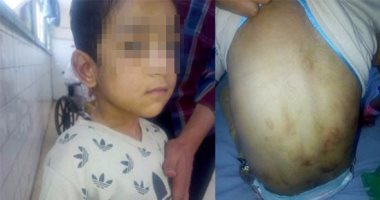 بالصور.. تفاصيل تعذيب أب لابنه وحرق جسده بالقناطر الخيرية.. الطفل: "والدى اعتاد تعذيبى وحرقى منذ طلاقه لأمى".. والنيابة تأمر بسرعة ضبط وإحضار الأب.. وأمن القليوبية يقدم الدعم المعنوى للطفل