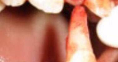 مفاجأة.. لو أسنان ابنك وقعت ممكن تركبيها تانى خلال 3 ساعات