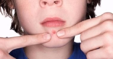 أسباب ظهور الدمامل وطرق الوقاية والعلاج