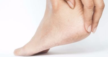 علاج تشقق القدمين بالكريمات المرطبة والحجر الجاف